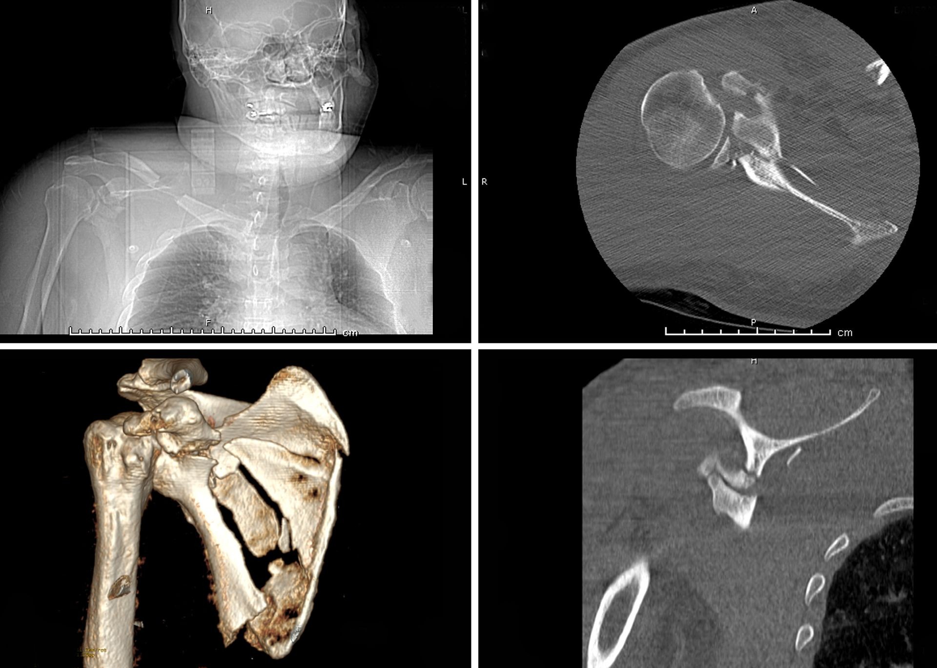 CT Scanner 2D and 3D maging of Right Shoulder Multiplanar View. painful or injury shoulder joint ,Fracture of shoulder. 